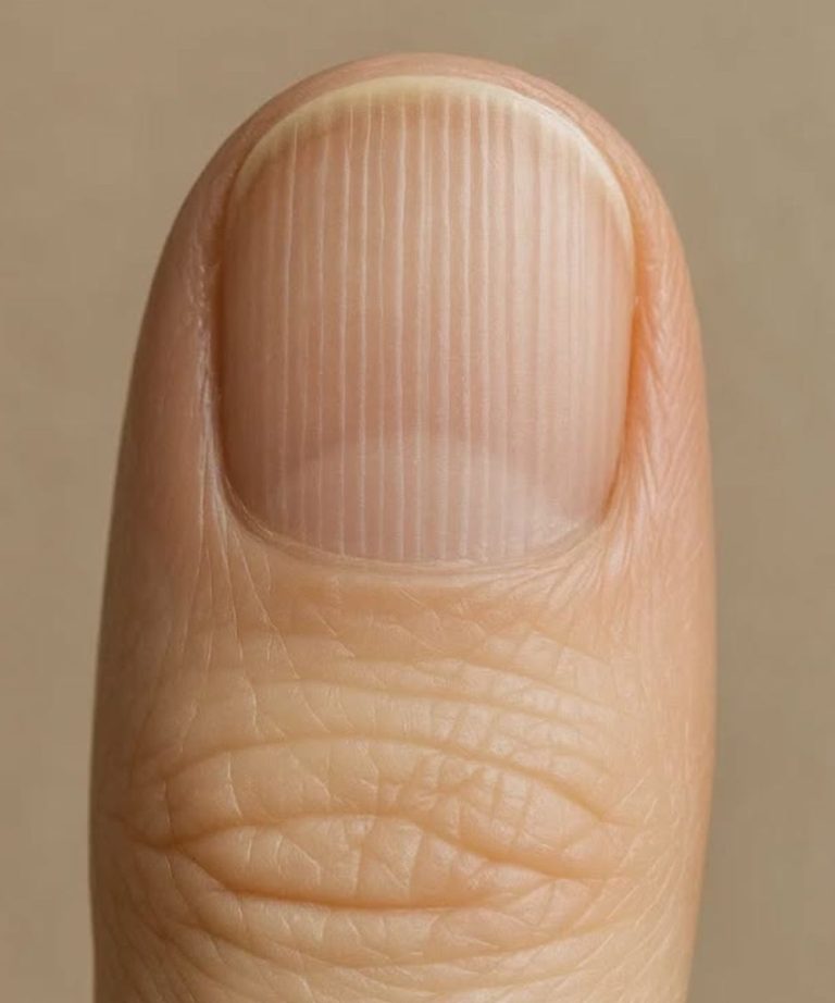 Having striped nails might be..