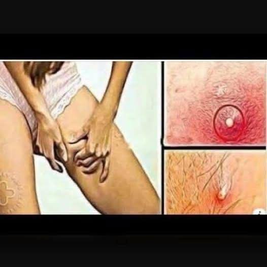 From Deep Wound to Recovery: The Healing Journey of a Severe Back Abscess