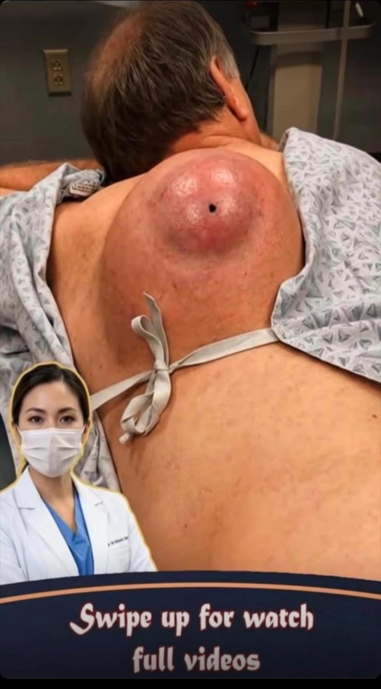 Their acne is severe