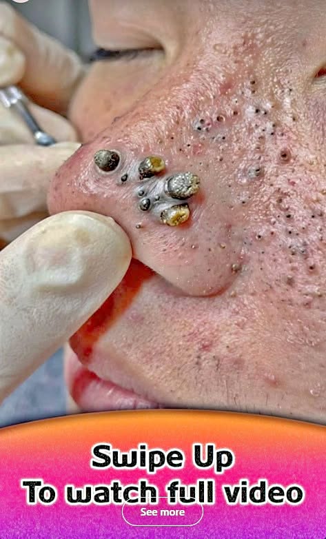 Why Acne on the Nose