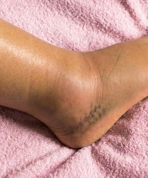 Swollen Legs: Understanding the Symptoms, Causes